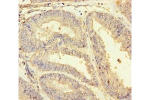 Immunohistochemistry of paraffin-embedded human endometrial cancer using ABIN7154855 at dilution of 1:100 (HSPA12B 抗体  (AA 201-500))