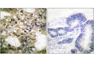 Immunohistochemistry analysis of paraffin-embedded human colon carcinoma tissue, using HDAC6 Antibody. (HDAC6 抗体  (AA 1166-1215))