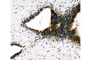 IHC-P: Annexin VII antibody testing of human breast cancer tissue (Annexin VII 抗体  (C-Term))