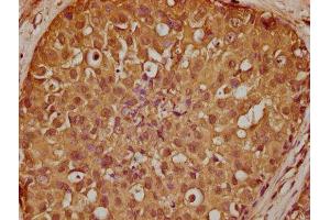 IHC image of ABIN7169172 diluted at 1:200 and staining in paraffin-embedded human breast cancer performed on a Leica BondTM system. (Sbk2 抗体  (AA 62-330))
