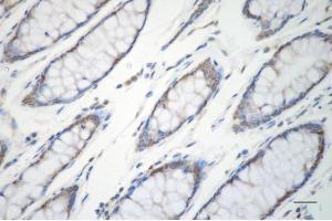 Immunohistochemistry was performed on paraffin-embedded human sigmoid colon carcinoma using ERK1 antibody (ABIN7799449), 1:200).