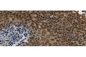 Immunohistochemistry of paraffin-embedded Human cervical cancer using SMAD4 Polyclonal Antibody at dilution of 1/40 (SMAD4 抗体)