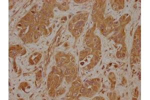 IHC image of ABIN7157890 diluted at 1:100 and staining in paraffin-embedded human liver cancer performed on a Leica BondTM system. (LAMb4 抗体  (AA 1513-1761))