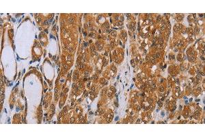 Immunohistochemistry of paraffin-embedded Human thyroid cancer tissue using ADAMTS15 Polyclonal Antibody at dilution 1:40 (ADAMTS15 抗体)