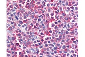 Anti-BEST2 / Bestrophin-2 antibody IHC of human Lymph Node, Non-Hodgkins Lymphoma. (Bestrophin 2 抗体  (Internal Region))