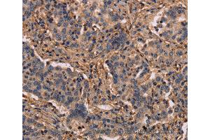 Immunohistochemistry of Human prostate cancer using MAP1LC3C Polyclonal Antibody at dilution of 1:40 (LC3C 抗体)