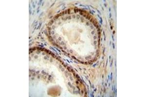 Immunohistochemistry analysis in formalin fixed and paraffin embedded human prostate carcinoma reacted with NUDT8 Antibody (N-term) followed by peroxidase conjugation of the secondary antibody and DAB staining. (NUDT8 抗体  (N-Term))