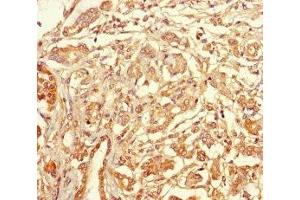 Immunohistochemistry of paraffin-embedded human pancreatic cancer using ABIN7171887 at dilution of 1:100 (Tetraspanin 7 抗体  (AA 113-223))
