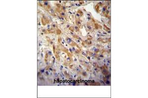 MET/HGFR Antibody (ABIN387742 and ABIN2838000) immunohistochemistry analysis in formalin fixed and paraffin embedded human hepatocarcinoma followed by peroxidase conjμgation of the secondary antibody and DAB staining. (c-MET 抗体  (Catalytic Domain))