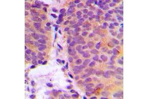 Immunohistochemical analysis of CHSY2 staining in human breast cancer formalin fixed paraffin embedded tissue section. (CHPF 抗体  (C-Term))
