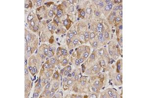 Immunohistochemistry of paraffin-embedded human liver cancer using GAS2 antibody.