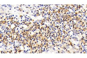 Detection of IL7R in Human Stomach cancer Tissue using Polyclonal Antibody to Interleukin 7 Receptor (IL7R)