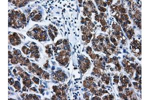Immunohistochemical staining of paraffin-embedded Carcinoma of liver tissue using anti-BIRC7mouse monoclonal antibody. (BIRC7 抗体)