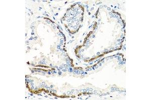 Immunohistochemistry of paraffin-embedded human prostate using BMP5 antibody. (BMP5 抗体  (AA 317-454))
