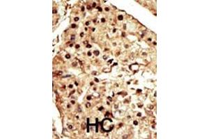 Formalin-fixed and paraffin-embedded human cancer tissue reacted with the primary antibody, which was peroxidase-conjugated to the secondary antibody, followed by DAB staining. (TRPM7 抗体  (C-Term))