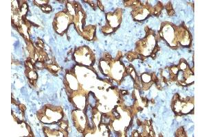 Formalin-fixed, paraffin-embedded human Angiosarcoma stained with CD34 Monoclonal Antibody (QBEnd/10 + HPCA1/763) (CD34 抗体)