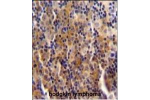 SYNE3 antibody (C-term) (ABIN654777 and ABIN2844458) immunohistochemistry analysis in formalin fixed and paraffin embedded human hodgkin lymphoma followed by peroxidase conjugation of the secondary antibody and DAB staining.