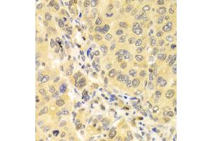 Immunohistochemistry of paraffin-embedded human liver cancer using IRF3 antibody (ABIN4904080) at dilution of 1:100 (40x lens). (IRF3 抗体)