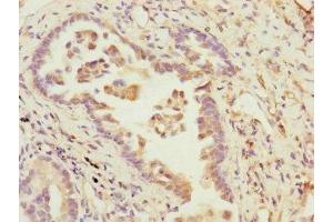 Immunohistochemistry of paraffin-embedded human lung cancer using ABIN7145189 at dilution of 1:100 (B9D2 抗体  (AA 1-175))
