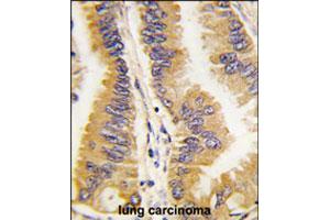 Formalin-fixed and paraffin-embedded human lung carcinoma tissue reacted with FRAT1 polyclonal antibody  , which was peroxidase-conjugated to the secondary antibody, followed by DAB staining. (FRAT1 抗体  (C-Term))
