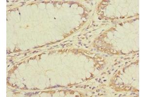 Immunohistochemistry of paraffin-embedded human colon cancer using ABIN7173139 at dilution of 1:100 (FAM156A 抗体  (AA 251-519))