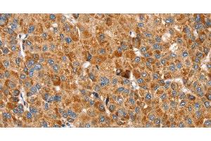 Immunohistochemistry of paraffin-embedded Human liver cancer using SSBP1 Polyclonal Antibody at dilution of 1:30 (SSBP1 抗体)