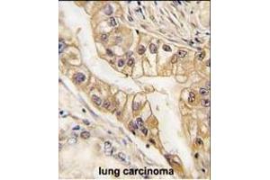 Formalin-fixed and paraffin-embedded human lung carcinoma tissue reacted with EPHB2 Monoclonal Antibody (ABIN387812 and ABIN2843903) , which was peroxidase-conjugated to the secondary antibody, followed by DAB staining. (EPH Receptor B2 抗体)