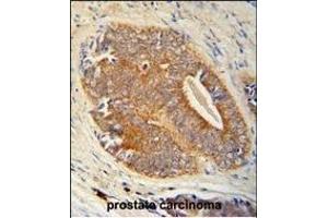 GAGE7 Antibody (C-term) (ABIN653712 and ABIN2843026) immunohistochemistry analysis in formalin fixed and paraffin embedded human prostate carcinoma followed by peroxidase conjugation of the secondary antibody and DAB staining. (G Antigen 7 抗体  (C-Term))
