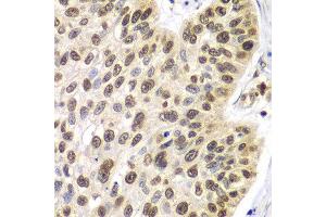 Immunohistochemistry of paraffin-embedded human lung cancer using 42254 antibody at dilution of 1:100 (x40 lens). (Septin 7 抗体)