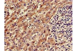 Immunohistochemistry of paraffin-embedded human liver cancer using ABIN7143656 at dilution of 1:100 (ADH5 抗体  (AA 14-130))