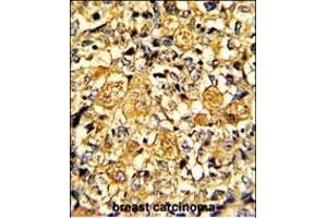 Formalin-fixed and paraffin-embedded human breast carcinoma with EGFR Monoclonal Antibody, which was peroxidase-conjugated to the secondary antibody, followed by DAB staining. (EGFR 抗体)