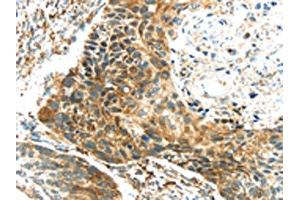 The image on the left is immunohistochemistry of paraffin-embedded Human esophagus cancer tissue using ABIN7131341(TGM4 Antibody) at dilution 1/20, on the right is treated with fusion protein. (TGM4 抗体)