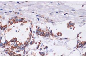Immunohistochemistry of paraffin-embedded Human gastric cancer using DVL2 Polyclonal Antibody at dilution of 1:100 (40x lens). (DVL2 抗体)