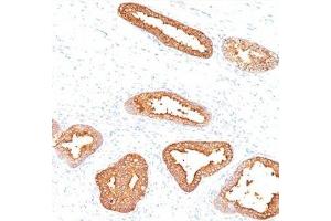IHC testing of human prostate carcinoma stained with PSA antibody. (Prostate Specific Antigen 抗体)