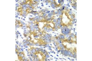 Immunohistochemistry of paraffin-embedded human gastric cancer using TFAM antibody.