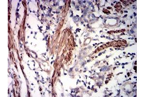 Immunohistochemical analysis of paraffin-embedded rectum cancer tissues using ACTA2 mouse mAb with DAB staining. (Smooth Muscle Actin 抗体  (AA 2-124))