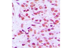 Immunohistochemical analysis of ETS1 (pT38) staining in human breast cancer formalin fixed paraffin embedded tissue section.