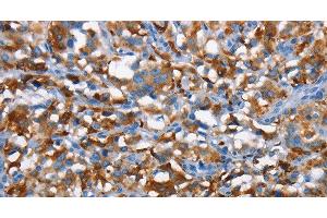 Immunohistochemistry of paraffin-embedded Human thyroid cancer tissue using CD226 Polyclonal Antibody at dilution 1:60 (CD226 抗体)