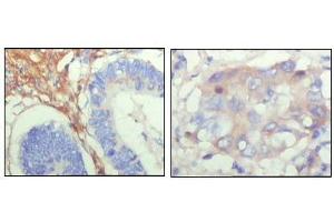 Immunohistochemical analysis of paraffin-embedded human colon cancer (left) and breast cancer (right) showing cytoplasmic localization with DAB staining using FBLN5 antibody. (Fibulin 5 抗体  (AA 242-448))