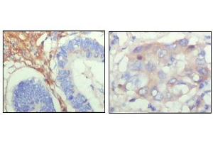 Immunohistochemical analysis of paraffin-embedded human colon cancer (left) and breast cancer (right) showing cytoplasmic localization with DAB staining using FBLN5 antibody.