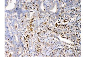 IHC analysis of Psoriasin using anti-Psoriasin antibody . (S100A7 抗体  (AA 2-101))