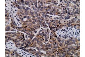 Immunohistochemical staining of paraffin-embedded Carcinoma of Human lung tissue using anti-NT5DC1 mouse monoclonal antibody. (NT5DC1 抗体)