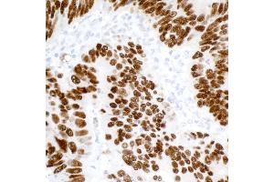 Immunohistochemistry (IHC) image for anti-Tumor Protein P53 (TP53) (AA 20-25) antibody (ABIN7455068)