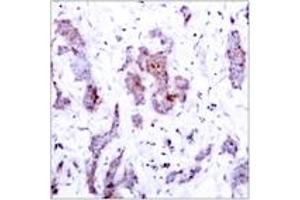 Immunohistochemistry analysis of paraffin-embedded human breast carcinoma tissue, using Rel (Ab-503) Antibody. (c-Rel 抗体  (AA 470-519))
