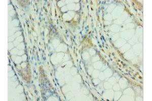 Immunohistochemistry of paraffin-embedded human colon cancer using ABIN7160504 at dilution of 1:100 (MEF2C 抗体  (AA 170-380))