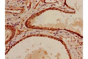 Immunohistochemistry of paraffin-embedded human prostate cancer using ABIN7169511 at dilution of 1:100 (SHC1 抗体  (AA 207-370))