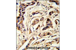 Formalin-fixed and paraffin-embedded human breast carcinoma reacted with TSHB Antibody , which was peroxidase-conjugated to the secondary antibody, followed by DAB staining. (TSHB 抗体  (AA 58-86))