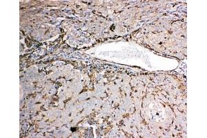 IHC-P: Gelsolin antibody testing of human lung cancer tissue. (Gelsolin 抗体  (AA 763-775))