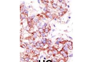 Formalin-fixed and paraffin-embedded human cancer tissue reacted with the primary antibody, which was peroxidase-conjugated to the secondary antibody, followed by AEC staining. (USP4 抗体  (C-Term))