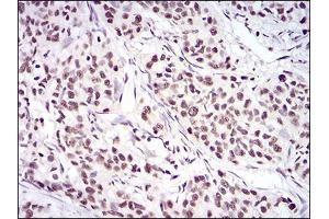 Immunohistochemical analysis of paraffin-embedded cervical cancer tissues using XRCC6 mouse mAb with DAB staining. (XRCC6 抗体  (AA 6-214))